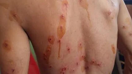 Pellet gun injuries (NH Photo)