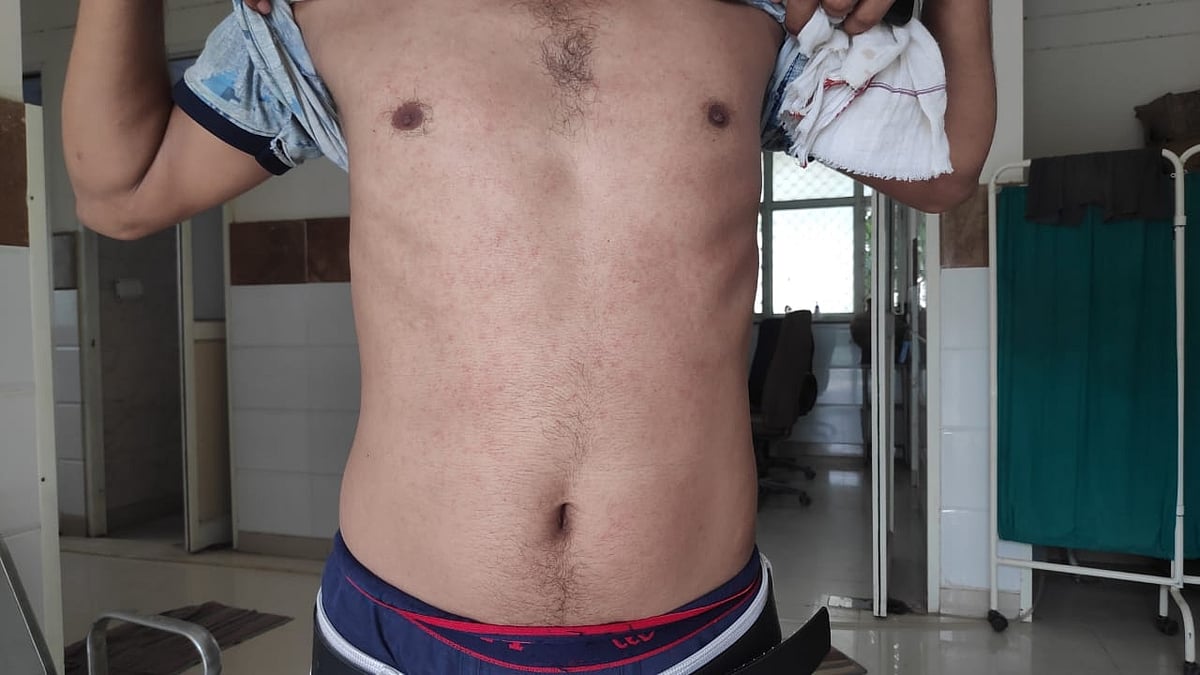 Rashes, fatigue & stigma: How ambulance workers are coping with COVID-19 pandemic