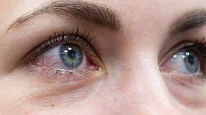 Amid conjunctivitis surge, doctors warn against irrational use of steroid eye drops