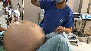 Medical wonder: Doctors in Delhi remove 50 kg ovarian tumour from a woman!
