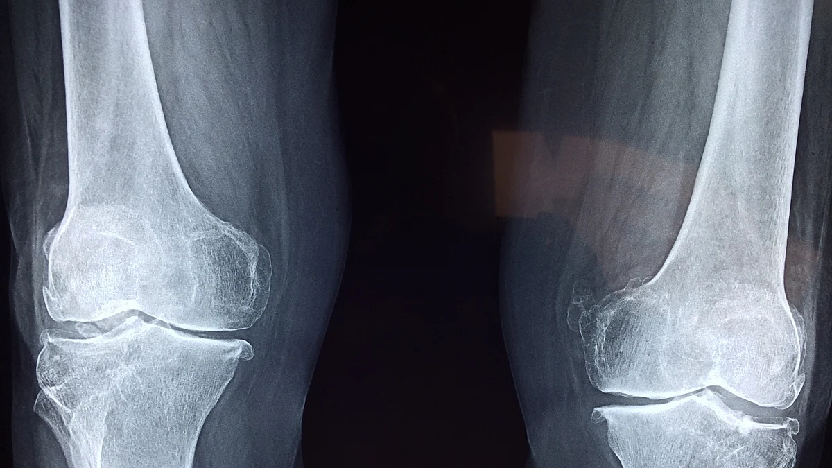 This alternative surgery may prevent total knee replacement