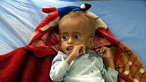 'Identifying, treating malnourished children crucial for healthy India'