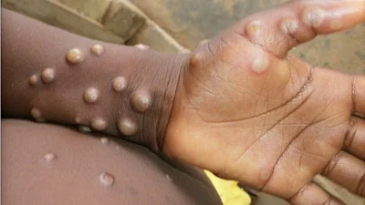 Monkeypox scare: TN district collectors on alert across the state