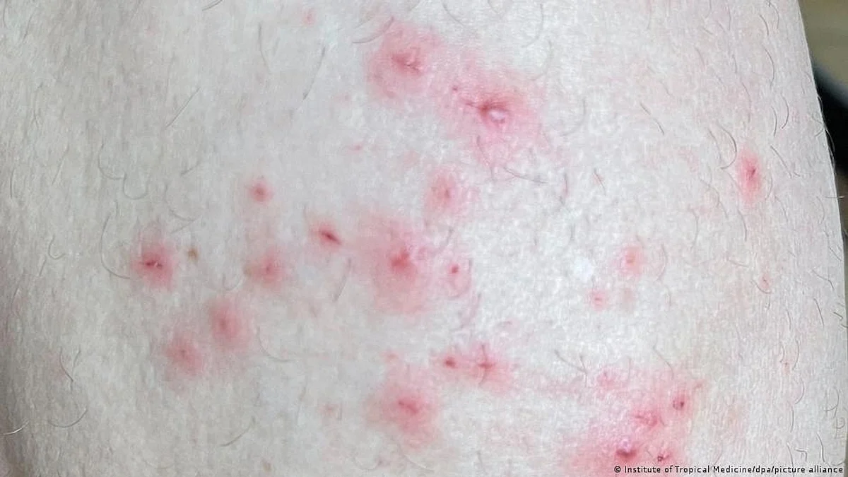 Monkeypox (photo courtesy: DW)