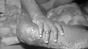 Monkeypox symptoms in UK patients differ from previous outbreaks: Lancet study