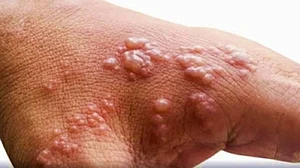 Centre forms task force to monitor monkeypox cases