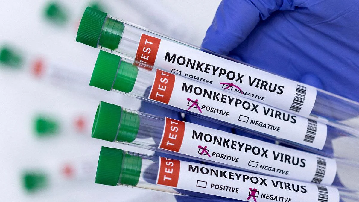 Monkeypox can become endemic: Here's how it can be stopped in its tracks
