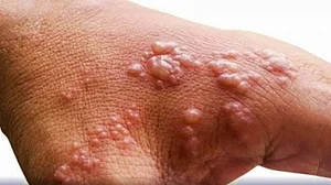 ICMR performs genome characterisation of monkeypox cases, identifies 3 sub-clusters among A.2 lineage in India