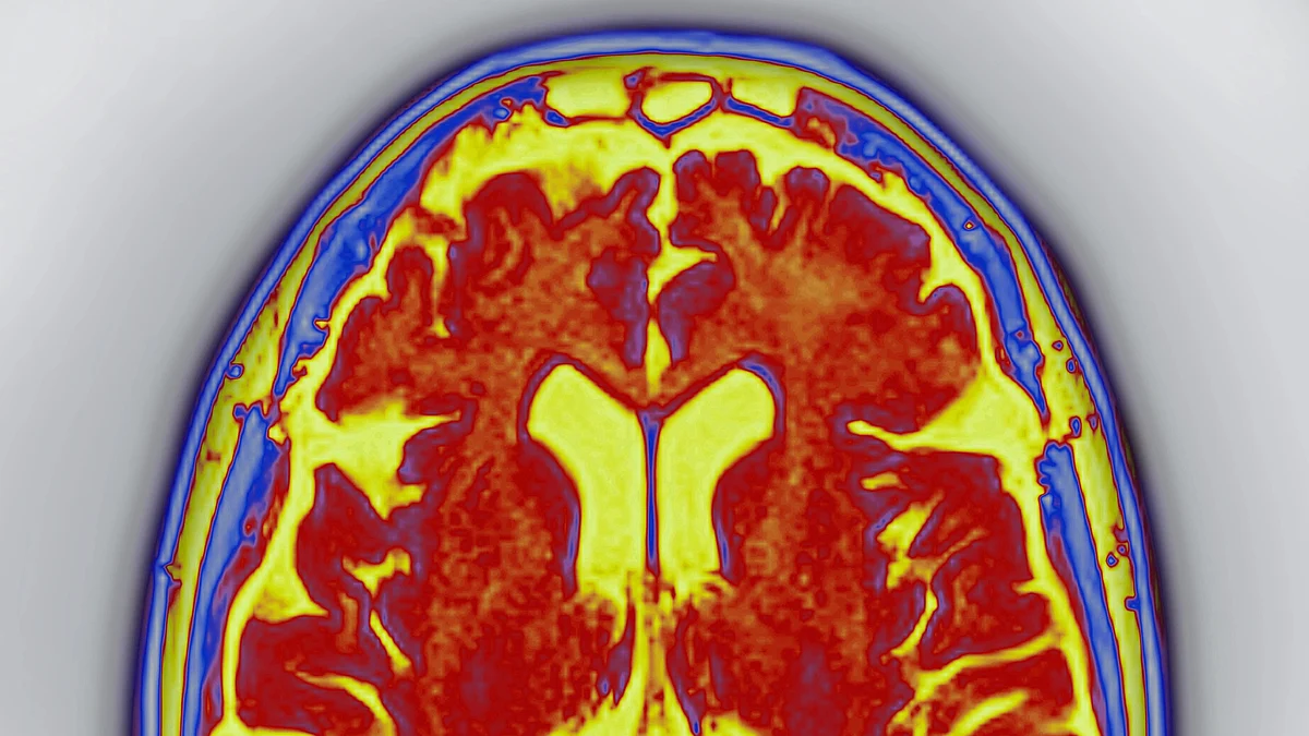 Cerebral atrophy (photo: Getty Images)