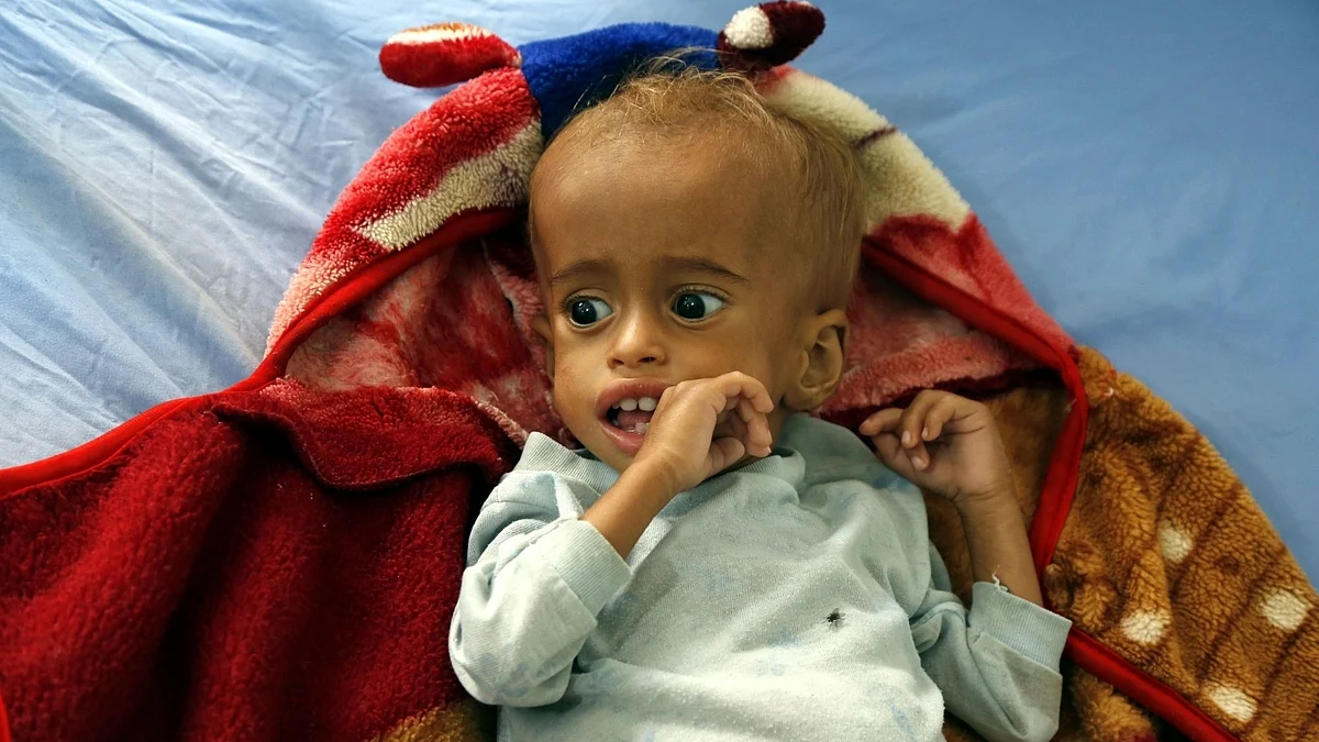 A malnourished child (Image for representative purpose only) (Photo: IANS)