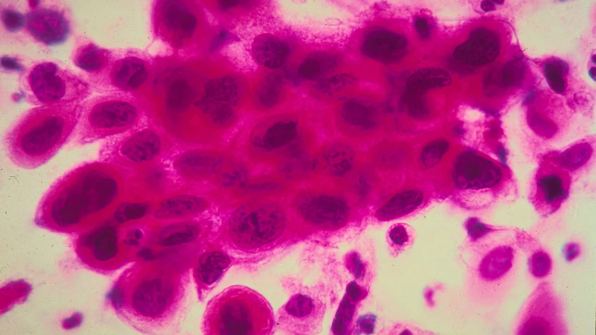 A microscopic image showing a close-up of cancer cells in the cervix. Cancer of the uterine cervix is the portion of the uterus attached to the top of the vagina, is being widely reported. (Photo by American Cancer Society/Getty Images)