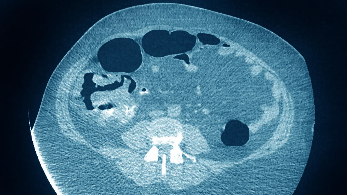 Representative image for Colon cancer (Photo: BSIP/Universal Images Group via Getty Images)