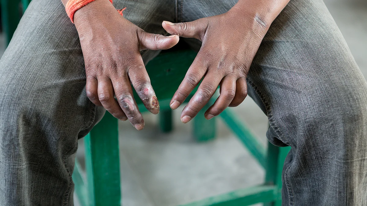 A man visiting a doctor because of his open wounds on his hands caused by the disease leprosy.  (Photo: Getty Images)