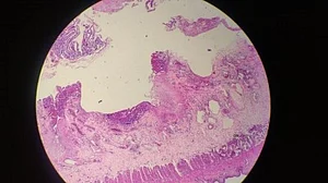 Global fungal disease deaths doubled in a decade: Study