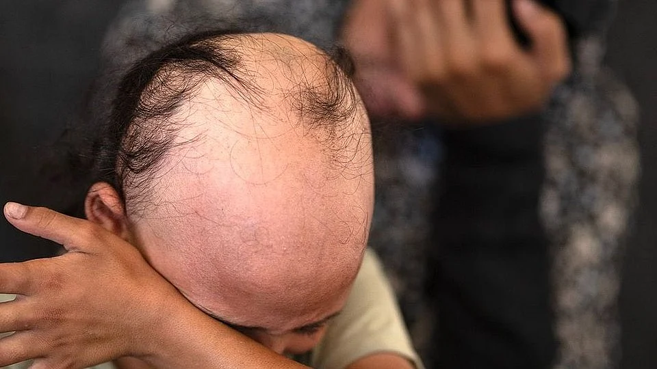 A child in Gaza who lost her hair from sheer stress and terror