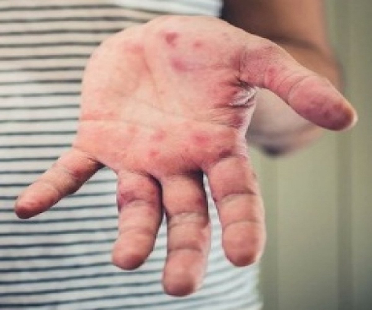 What is tomato flu All you need to know