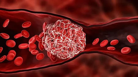 World thrombosis day blood clot symptoms risk prevention.