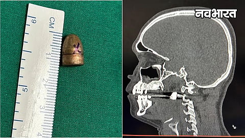 jj hospital mumbai successful skull base surgery bullet removed gsp26