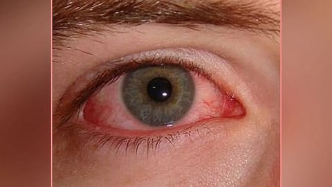 Conjunctivitis