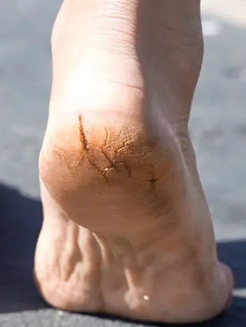 Macro photo pair of cracked heels. Male back view.