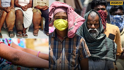Elephantiasis and Kala-azar diseases spreading in Bihar