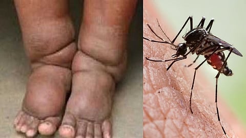know the elephantiasis symptoms and prevention measures