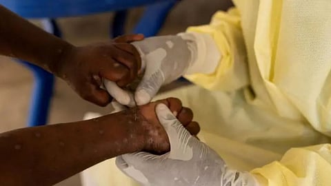 मंकी पॉक्स को WHO ने घोषित किया ग्लोबल हेल्थ इमरजेंसी, अब 11000 लोगों की मौत