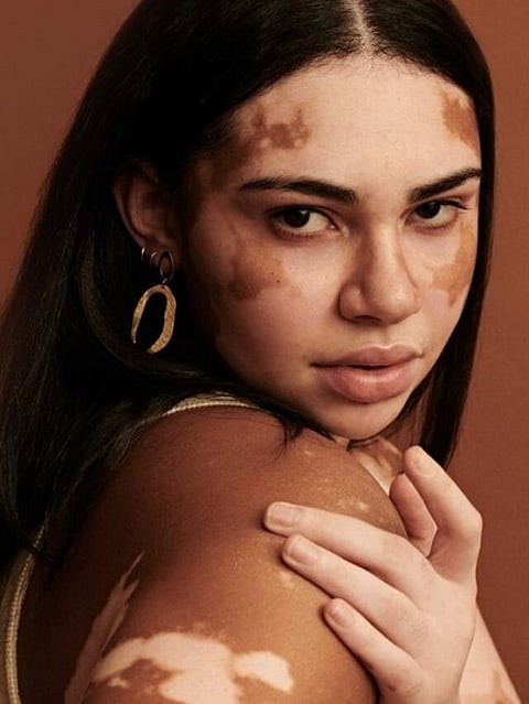 Vitiligo