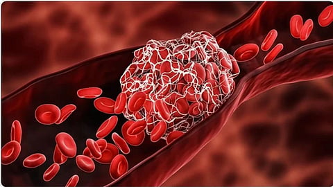 Thrombosis, हेल्थ