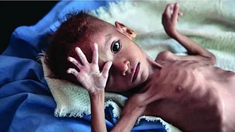 भंडारा जिले में 149 अति-गंभीर कुपोषित बच्चे