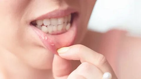 मुंह में छालों से हैं परेशान? जानिए क्या है इसकी वजह और अपनाएं ये 5 असरदार घरेलू नुस्खे