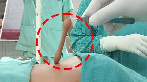 A 1.5-year-old boy in Lucknow was found with a rare 14 cm tail caused by spina bifida occulta, which doctors successfully removed through a highly delicate surgery.