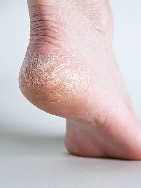 cracked heels remedies