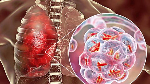 mumbai-tb-control-success-drtb-recovery-rate-bmc-report