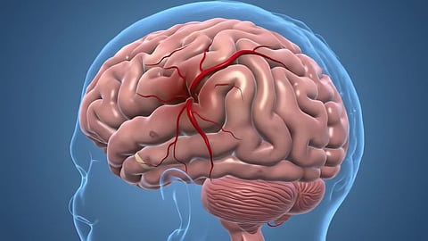 Early Warning Signs Of Brain Stroke