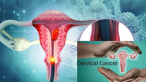 Chhatrapati Sambhajinagar: To prevent cervical cancer, free HPV vaccination campaign for over 21,000 adolescent girls begins