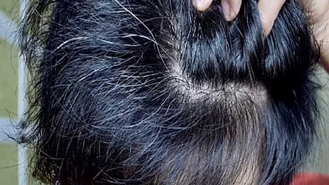 White Hair Problem In Children