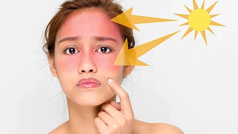 Sunburn Skin Care