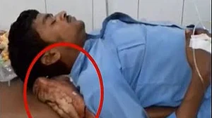 यूपी के योगी राज में सरकारी मशीनरी की दिल दहला देने वाली लापरवाही, घायल के कटे पैर को ही लगा दिया सिरहाने