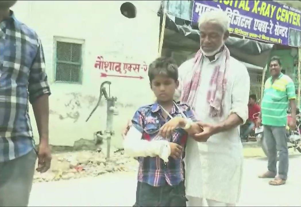 बिहार में डॉक्टरों की बड़ी लापरवाही, फ्रैक्चर हुआ था बाएं हाथ में, प्लास्टर चढ़ा दिया दाएं पर