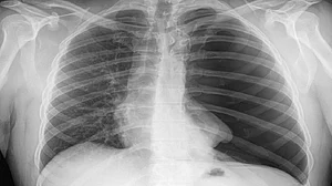 भारतीय डॉक्टरों को मिली कामयाबी, अब सीने का X-Ray बताएगा मरीज कोरोना संक्रमित है या नहीं