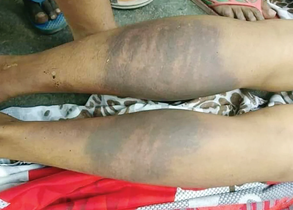 बिहार के भागलपुर में हिरासत में इंजीनियर की मौत अकेला उदाहरण नहीं है पुलिस बर्बरता का, लेकिन कर कोई कुछ नहीं रहा