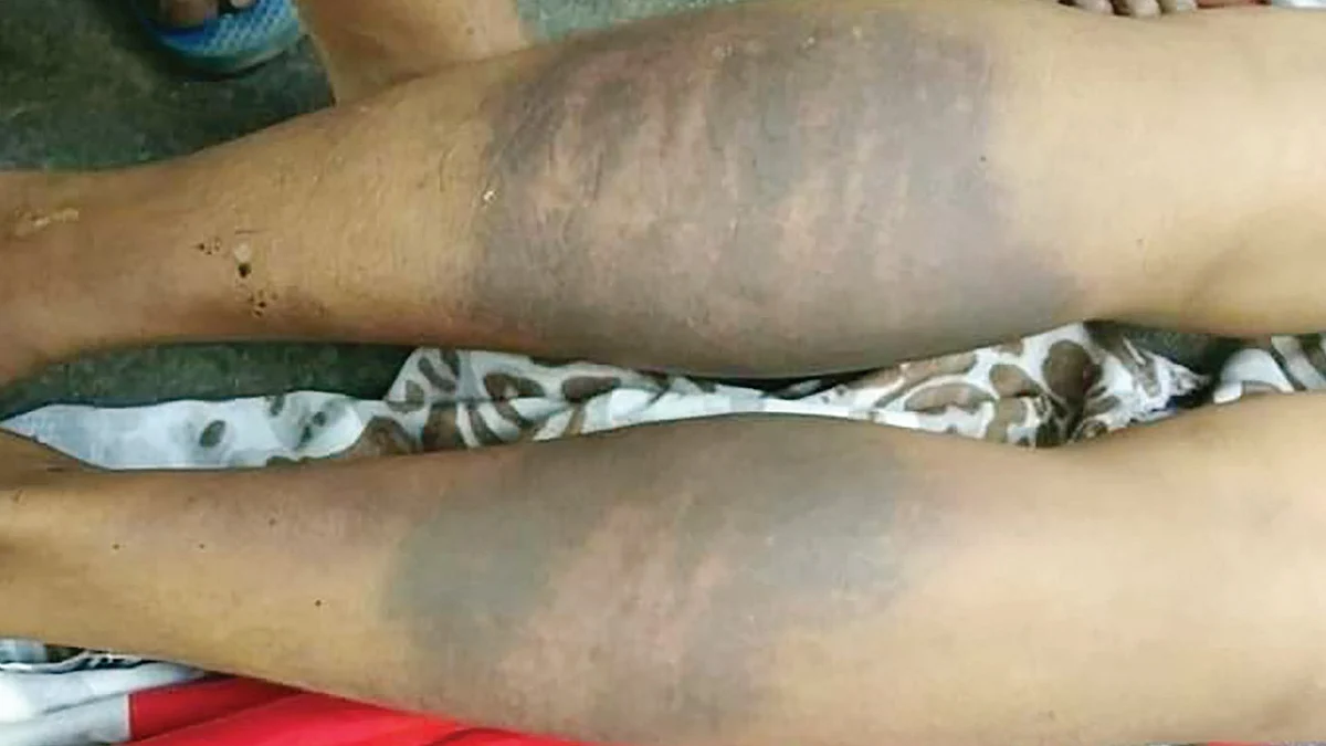 यह भागलपुर में इंजीनियर आशुतोष कुमार की पुलिस पिटाई से संबंधित फोटो है जो सोशल मीडिया में वायरल है। पूरे शरीर की फोटो वीभत्स है इसलिए उसका
उपयोग हम नहीं कर रहे हैं। लेकिन इतना ही देखने से अंदाजा लग जाता है कि पुलिस ने आशुतोष के साथ क्या किया होगा।