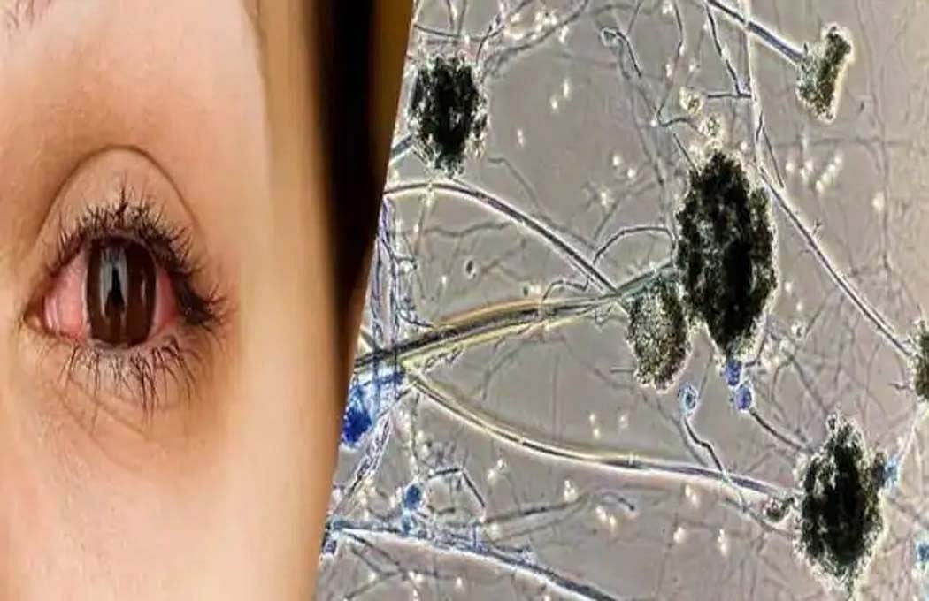 वीडियो: कोरोना से संक्रमितों पर कहर बनकर टूट रहा ब्लैक फंगस! जानें इसके लक्षण और बचने का तरीका