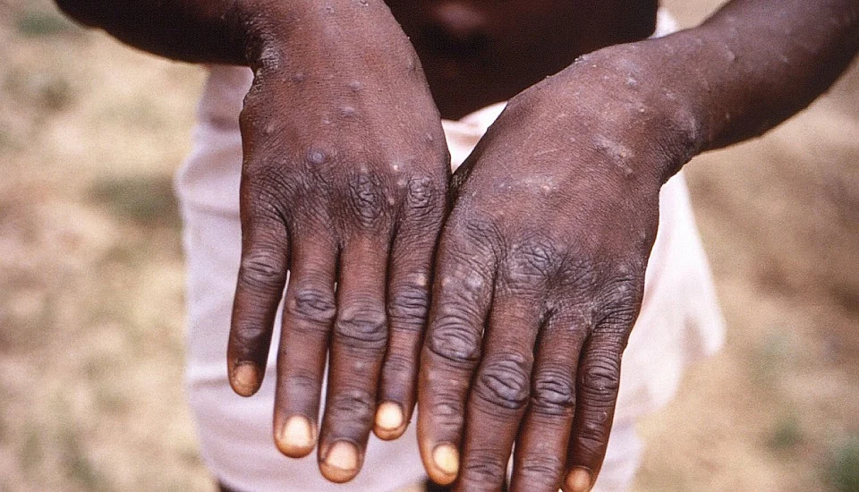 देश में बढ़ रहे मंकी पॉक्स के मामले, सतर्क रहने की जरूरत, जानें कहां से आई ये बीमारी, कितना है खतरा और कैसे करें बचाव