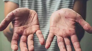 तेजी से फैल रहा एमपॉक्स का प्रकोप, अब तक 524 की मौत, WHO ने घोषित की वर्ल्ड हेल्थ इमरजेंसी