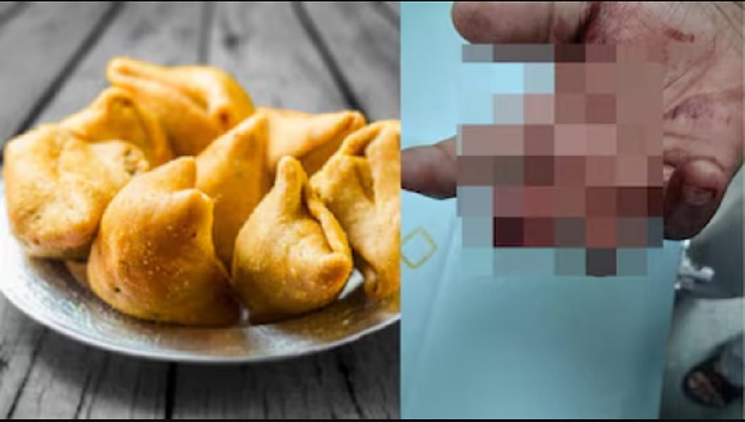 मुंबई में खाने के बिल को लेकर बवाल, ग्राहक ने दांतों से काटकर अलग कर दी दुकानदार की अंगुली