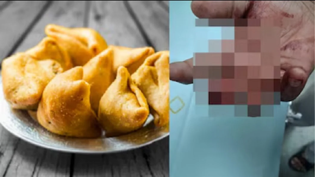 मुंबई में खाने के बिल को लेकर बवाल, ग्राहक ने दांतों से काटकर अलग कर दी दुकानदार की अंगुली