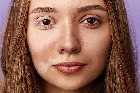 A skin disorder called Pityriasis Alba.  (Pixabay)