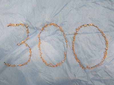 300 kidney stones removed from 75-yr-old farmer. (IANS)